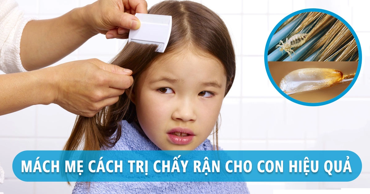 Cách trị chấy rận hiệu quả cho trẻ mẹ nên biết