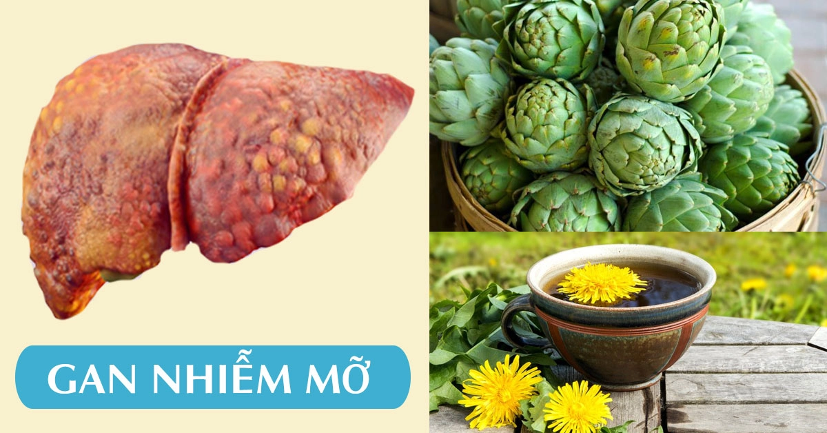 Gan nhiễm mỡ uống gì?