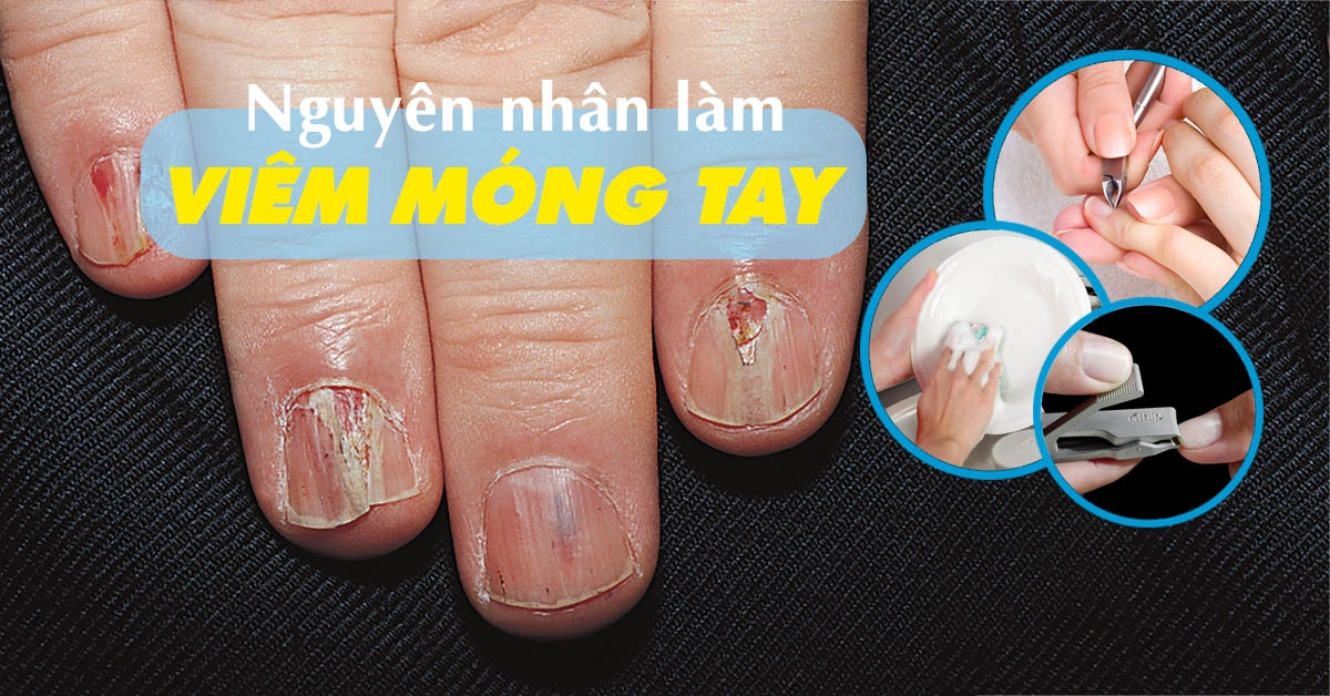 Nguyên nhân gây viêm móng tay và cách điều trị