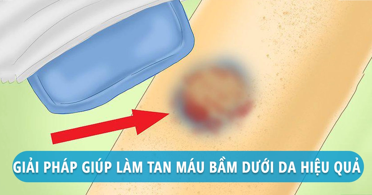 Cách làm tan máu bầm hiệu quả tại nhà