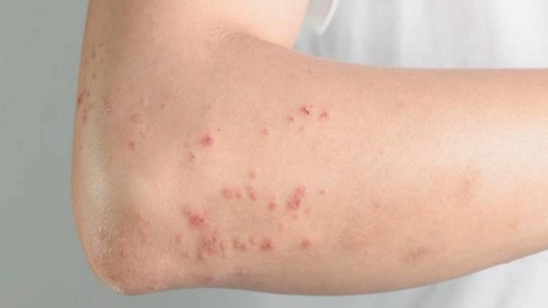 Dấu hiệu nhiễm giun đũa chó mèo ở trẻ em